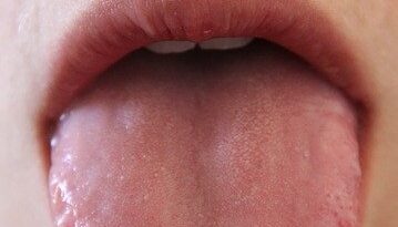 What Your Tongue Says About Your Health