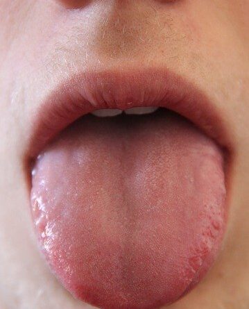 What Your Tongue Says About Your Health