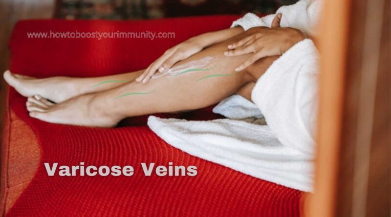 Home Remedies To Get Rid Of Varicose Veins